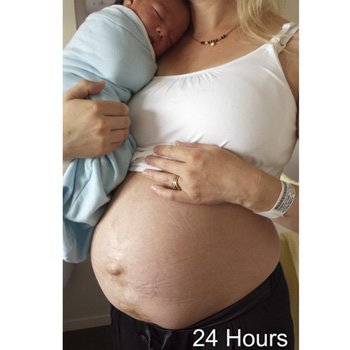 Forme du ventre après l'accouchement